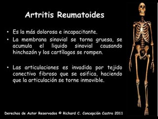 Artritis Reumatoides

 • Es la más dolorosa e incapacitante.
 • La membrana sinovial se torna gruesa, se
   acumula el liquido sinovial causando
   hinchazón y los cartílagos se rompen.

 • Las articulaciones es invadida por tejido
   conectivo fibroso que se osifica, haciendo
   que la articulación se torne inmovible.




Derechos de Autor Reservados © Richard C. Concepción Castro 2011
 