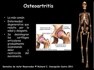 Osteoartritis

 • La más común.
 • Enfermedad
   degenerativa que
   resulta por la
   edad y desgaste.
 • Se desintegran
   los     cartílagos
   articulares
   gradualmente
   ocasionando
   dolor            y
   restricción    del
   movimiento.


Derechos de Autor Reservados © Richard C. Concepción Castro 2011
 