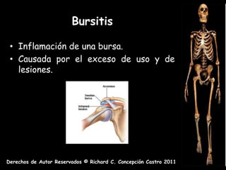 Bursitis

 • Inflamación de una bursa.
 • Causada por el exceso de uso y de
   lesiones.




Derechos de Autor Reservados © Richard C. Concepción Castro 2011
 