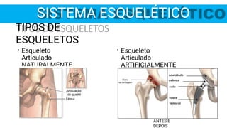 SISTEMA ESQUELÉTICO
TIPOS DE
ESQUELETOS
• Esqueleto
Articulado
ARTIFICIALMENTE
• Esqueleto
Articulado
NATURALMENTE
ANTES E
DEPOIS
 