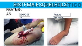 SISTEMA ESQUELÉTICO
FRATUR
AS Fratura
Fechada
EXPOST
A
 
