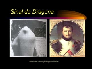Sinal da Dragona
Fonte:www.semiologiaortopedica.com.br
 