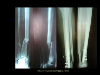 Fonte:www.semiologiaortopedica.com.br
 