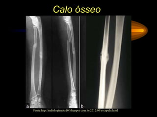 Calo ósseo
 