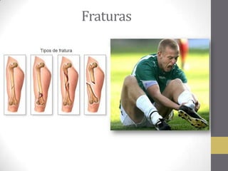 Fraturas
 