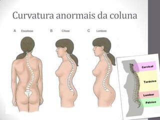 Curvatura anormais da coluna
 