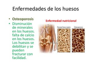 Enfermedades de los huesos
• Osteoporosis
• Disminución
de minerales
en los huesos.
falta de calcio
en los huesos.
Los huesos se
debilitan y se
pueden
fracturar con
facilidad.
Enfermedad nutricional
 