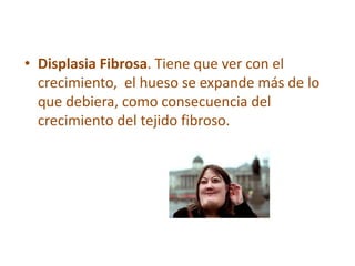 • Displasia Fibrosa. Tiene que ver con el
crecimiento, el hueso se expande más de lo
que debiera, como consecuencia del
crecimiento del tejido fibroso.
 