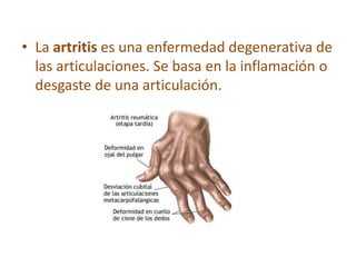 • La artritis es una enfermedad degenerativa de
las articulaciones. Se basa en la inflamación o
desgaste de una articulación.
 