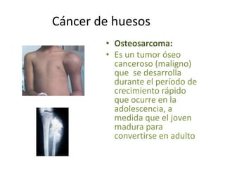 Cáncer de huesos
• Osteosarcoma:
• Es un tumor óseo
canceroso (maligno)
que se desarrolla
durante el período de
crecimiento rápido
que ocurre en la
adolescencia, a
medida que el joven
madura para
convertirse en adulto
 