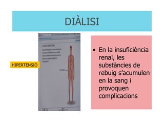 DIÀLISI En la insuficiència renal, les substàncies de rebuig s’acumulen en la sang i provoquen complicacions HIPERTENSIÓ 