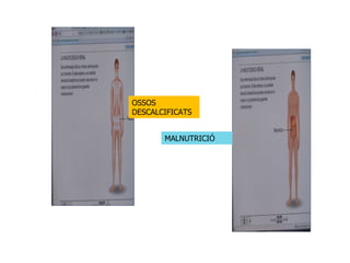 OSSOS DESCALCIFICATS  MALNUTRICIÓ 