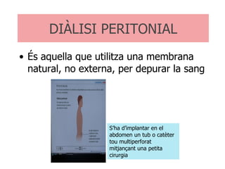 DIÀLISI PERITONIAL És aquella que utilitza una membrana natural, no externa, per depurar la sang S’ha d’implantar en el abdomen un tub o catèter tou multiperforat mitjançant una petita cirurgia 