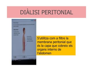 DIÀLISI PERITONIAL S’utilitza com a filtre la membrana peritonial que és la capa que cobreix els organs interns de l’abdomen 