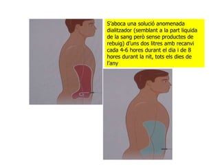 S’aboca una solució anomenada dialitzador (semblant a la part liquida de la sang però sense productes de rebuig) d’uns dos litres amb recanvi cada 4-6 hores durant el dia i de 8 hores durant la nit, tots els dies de l’any 