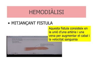 MITJANÇANT FISTULA HEMODIÀLISI Aquesta fistula consisteix en la unió d’una artèria i una vena per augmentar el cabal i la velocitat sanguinia 