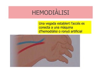 HEMODIÀLISI Una vegada establert l’accés es conecta a una màquina d’hemodiàlisi o ronyó artificial 