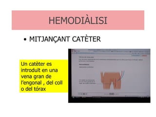 HEMODIÀLISI MITJANÇANT CATÈTER Un catèter es introduït en una vena gran de l’engonal , del coll o del tórax  