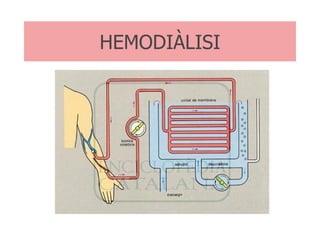 HEMODIÀLISI 