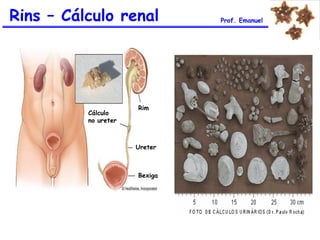 Rins – Cálculo renal Prof. Emanuel
Rim
Cálculo
no ureter
Ureter
Bexiga
 