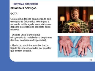 18
SISTEMA EXCRETORSISTEMA EXCRETOR
PRINCIPAIS DOENÇAS
GOTA
Gota é uma doença caracterizada pela
elevação de ácido úrico no sangue e
surtos de artrite aguda secundários ao
depósito de cristais do sal deste ácido
(uratos).
- O ácido úrico é um resíduo
nitrogenado do metabolismo de purinas
(lembrar das bases nitrogenadas).
- Mariscos, sardinha, salmão, bacon,
fígado devem ser evitados por aqueles
que sofrem de gota.
 