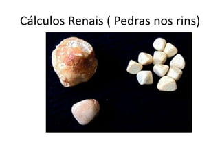 Cálculos Renais ( Pedras nos rins)
 