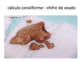 cálculo coraliforme - chifre de veado
 