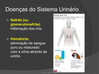 Doenças do Sistema Urinário
 Nefrite (ou
glomerulonefrite):
inflamação dos rins.
 Hematúria:
eliminação de sangue
puro ou misturado
com a urina através da
uretra.
Ciências Naturais - ICRM 25
 