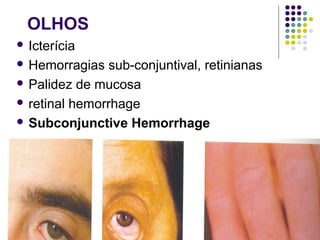 OLHOS
 Icterícia 
 Hemorragias sub-conjuntival, retinianas 
 Palidez de mucosa 
 retinal hemorrhage 
 Subconjunctive Hemorrhage
 
 
 
