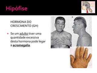 HORMONA DO
    CRESCIMENTO (GH)

   Se um adulto tiver uma
    quantidade excessiva
    desta hormona pode legar
    à acromegalia.
 
