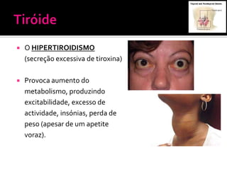    O HIPERTIROIDISMO
    (secreção excessiva de tiroxina)

   Provoca aumento do
    metabolismo, produzindo
    excitabilidade, excesso de
    actividade, insónias, perda de
    peso (apesar de um apetite
    voraz).
 