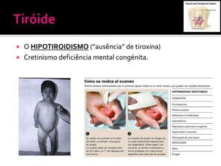  O HIPOTIROIDISMO (“ausência” de tiroxina)
 Cretinismo deficiência mental congénita.
 