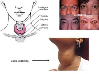 exoftalmia




Bócio Endêmico
 