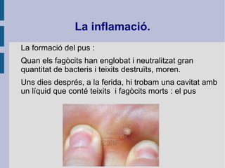 La inflamació.
La formació del pus :
Quan els fagòcits han englobat i neutralitzat gran
quantitat de bacteris i teixits destruïts, moren.
Uns dies després, a la ferida, hi trobam una cavitat amb
un líquid que conté teixits i fagòcits morts : el pus
 