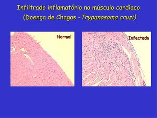 Infiltrado inflamatório no músculo cardíaco
  (Doença de Chagas -Trypanosoma cruzi)


             Normal                   Infectado
 