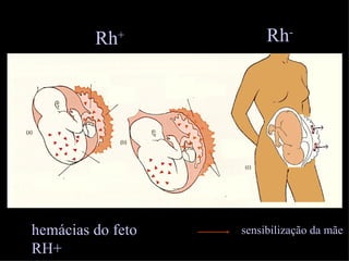 Rh   +         Rh-




hemácias do feto   sensibilização da mãe
RH+
 