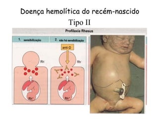 Doença hemolítica do recém-nascido
             Tipo II
 