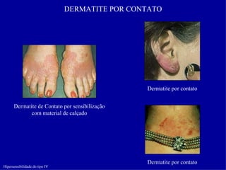 DERMATITE POR CONTATO




                                                 Dermatite por contato


      Dermatite de Contato por sensibilização
             com material de calçado




                                                 Dermatite por contato
Hipersensibilidade do tipo IV
 