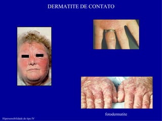 DERMATITE DE CONTATO




                                                 fotodermatite
Hipersensibilidade do tipo IV
 