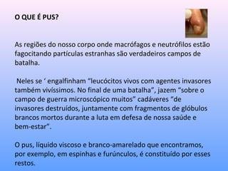 O QUE É PUS?
As regiões do nosso corpo onde macrófagos e neutrófilos estão
fagocitando partículas estranhas são verdadeiros campos de
batalha.
Neles se ‘ engalfinham “leucócitos vivos com agentes invasores
também vivíssimos. No final de uma batalha”, jazem “sobre o
campo de guerra microscópico muitos” cadáveres “de
invasores destruídos, juntamente com fragmentos de glóbulos
brancos mortos durante a luta em defesa de nossa saúde e
bem-estar”.
O pus, líquido viscoso e branco-amarelado que encontramos,
por exemplo, em espinhas e furúnculos, é constituído por esses
restos.
 