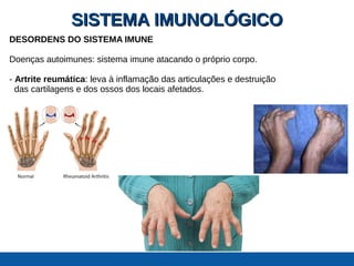 SISTEMA IMUNOLÓGICOSISTEMA IMUNOLÓGICO
DESORDENS DO SISTEMA IMUNE
Doenças autoimunes: sistema imune atacando o próprio corpo.
- Artrite reumática: leva à inflamação das articulações e destruição
das cartilagens e dos ossos dos locais afetados.
 