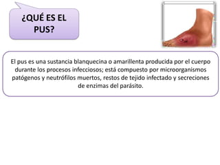 El pus es una sustancia blanquecina o amarillenta producida por el cuerpo
durante los procesos infecciosos; está compuesto por microorganismos
patógenos y neutrófilos muertos, restos de tejido infectado y secreciones
de enzimas del parásito.
¿QUÉ ES EL
PUS?
 