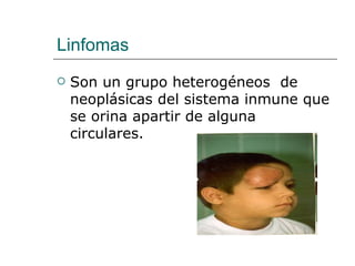 Linfomas  Son un grupo heterogéneos  de neoplásicas del sistema inmune que se orina apartir de alguna circulares.  