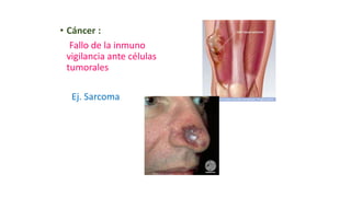 • Cáncer :
Fallo de la inmuno
vigilancia ante células
tumorales
Ej. Sarcoma
 