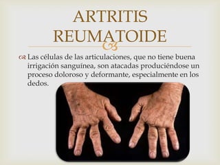 ARTRITIS
REUMATOIDE


 Las células de las articulaciones, que no tiene buena
irrigación sanguínea, son atacadas produciéndose un
proceso doloroso y deformante, especialmente en los
dedos.

 