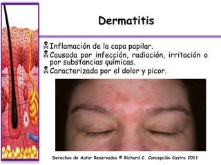 Dermatitis

 Inflamación de la capa papilar.
 Causada por infección, radiación,                 irritación o
  por substancias químicas.
 Caracterizada por el dolor y picor.




  Derechos de Autor Reservados © Richard C. Concepción Castro 2011
 