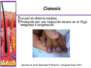 Cianosis

 La piel se observa azulosa.
 Producida por una reducción severa en el flujo
 sanguíneo o oxigenación.




  Derechos de Autor Reservados © Richard C. Concepción Castro 2011
 
