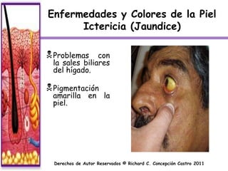 Enfermedades y Colores de la Piel
      Ictericia (Jaundice)

 Problemas    con
 la sales biliares
 del hígado.

 Pigmentación
 amarilla en la
 piel.




  Derechos de Autor Reservados © Richard C. Concepción Castro 2011
 