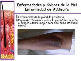 Enfermedades y Colores de la Piel
     Enfermedad de Addison’s

 Enfermedad de la glándula pituitaria.
 Pigmentación oscura sobre la piel (Color marrón
  o bronce oscuro mejor conocido como ictericia
  negra)




  Derechos de Autor Reservados © Richard C. Concepción Castro 2011
 