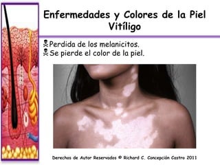 Enfermedades y Colores de la Piel
            Vitíligo
 Perdida de los melanicitos.
 Se pierde el color de la piel.




   Derechos de Autor Reservados © Richard C. Concepción Castro 2011
 